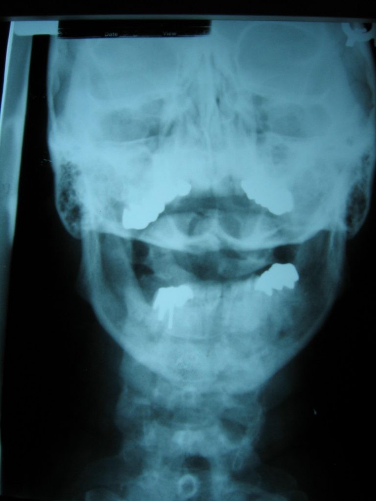 상부 경추 척추 교정 지압 요법